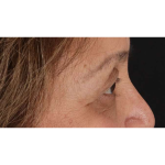Eyelid Surgery Before & After Patient #1803