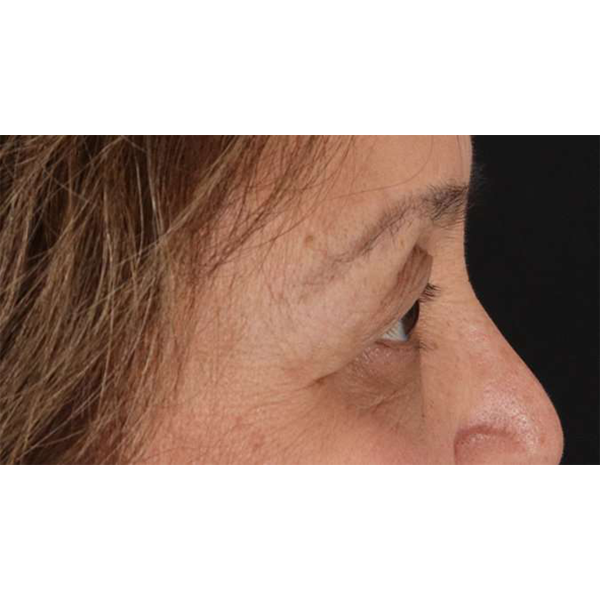 Eyelid Surgery Before & After Patient #1803