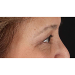 Eyelid Surgery Before & After Patient #1803