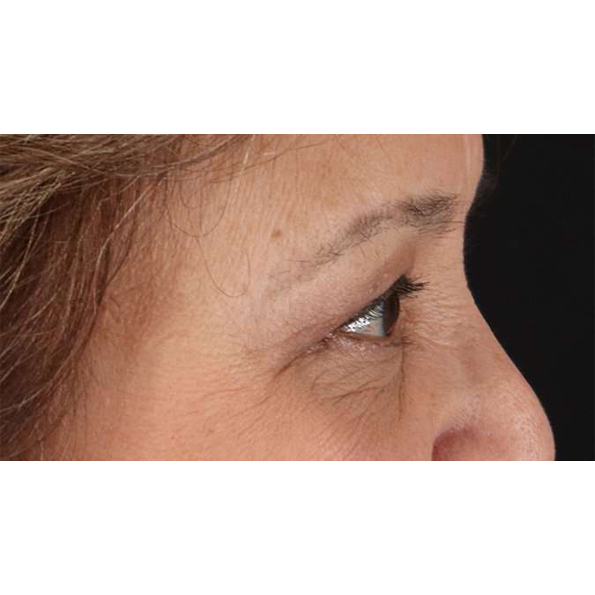 Eyelid Surgery Before & After Patient #1803