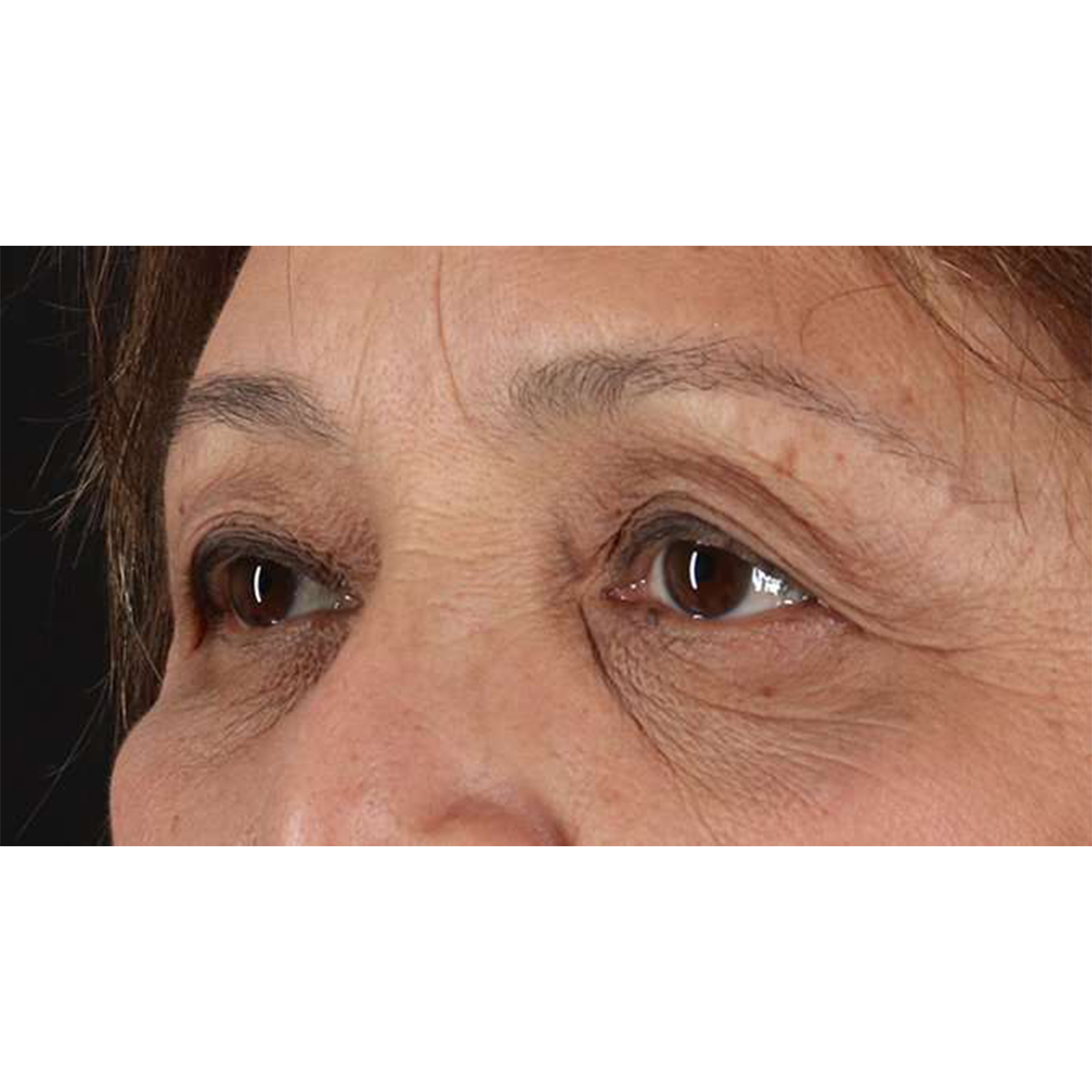 Eyelid Surgery Before & After Patient #1803