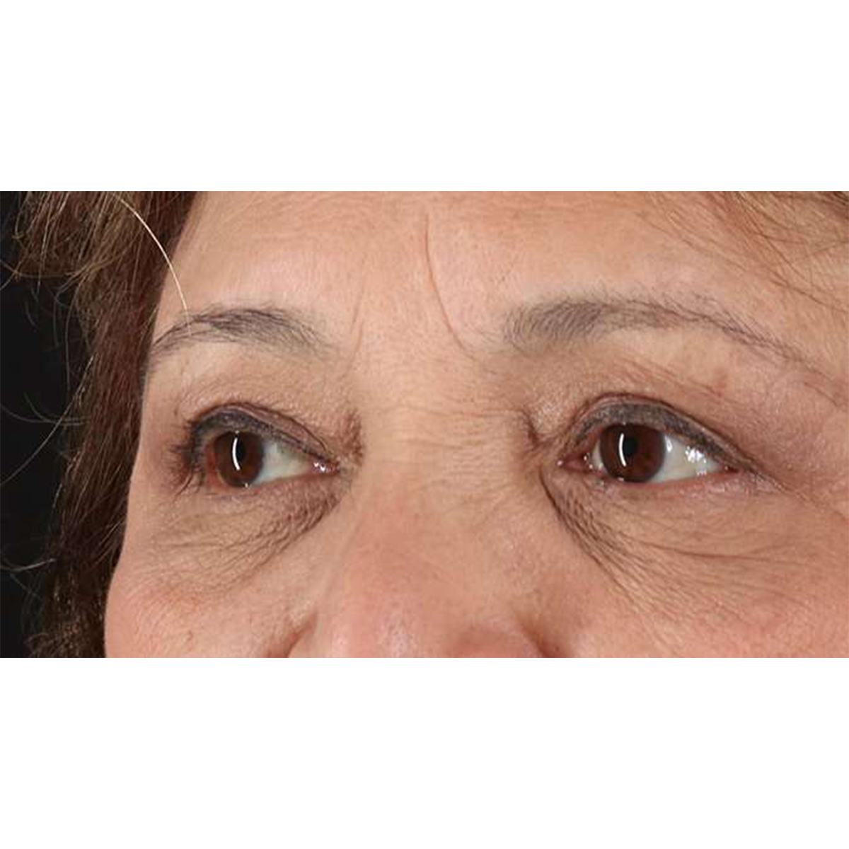 Eyelid Surgery Before & After Patient #1803