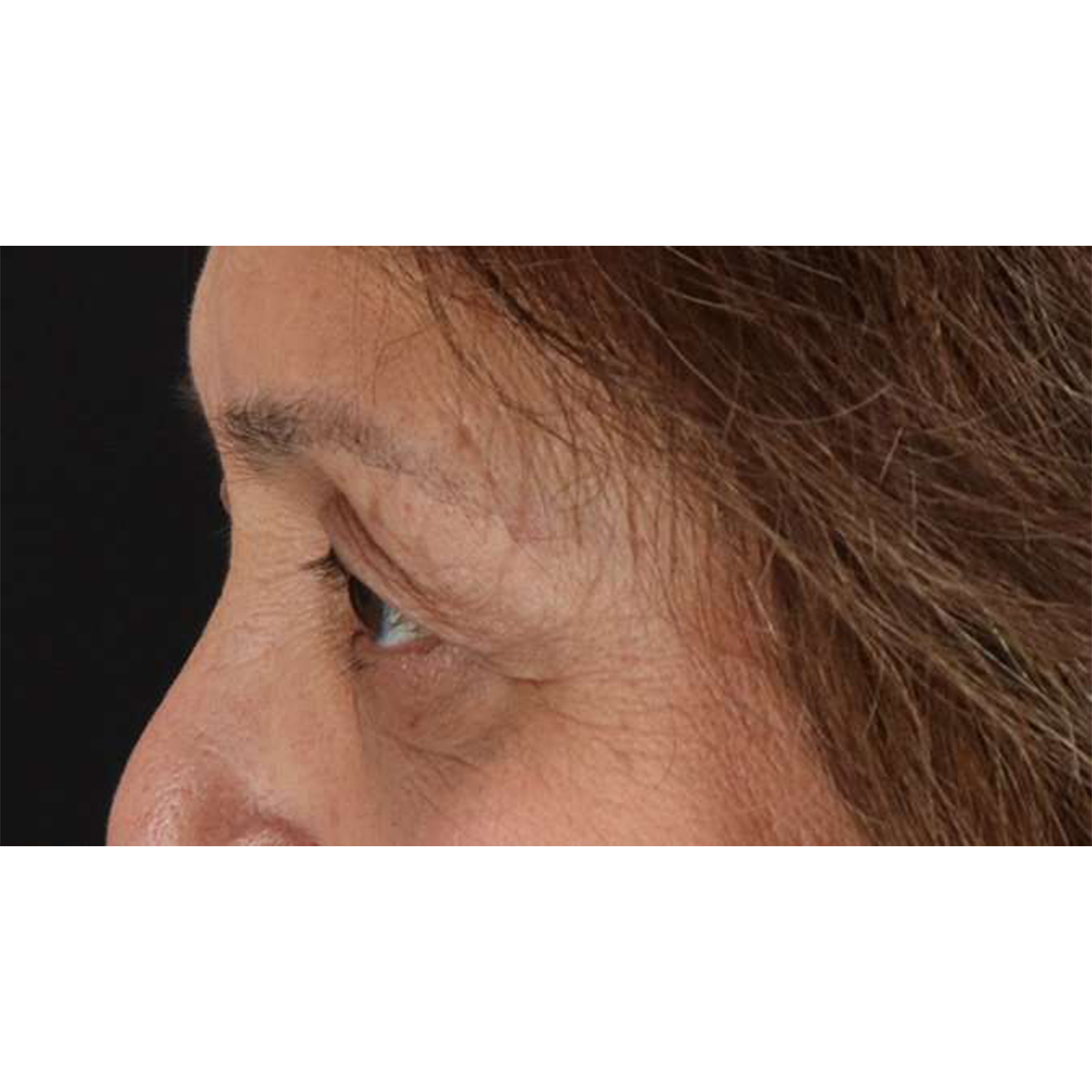 Eyelid Surgery Before & After Patient #1803