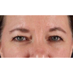 Eyelid Surgery Before & After Patient #1814