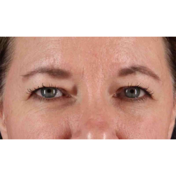Eyelid Surgery Before & After Patient #1814