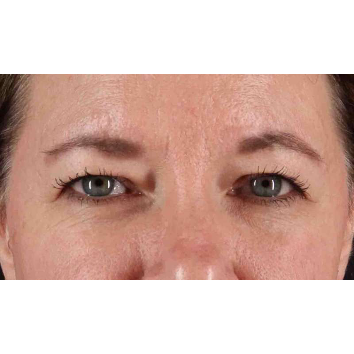 Eyelid Surgery Before & After Patient #1814