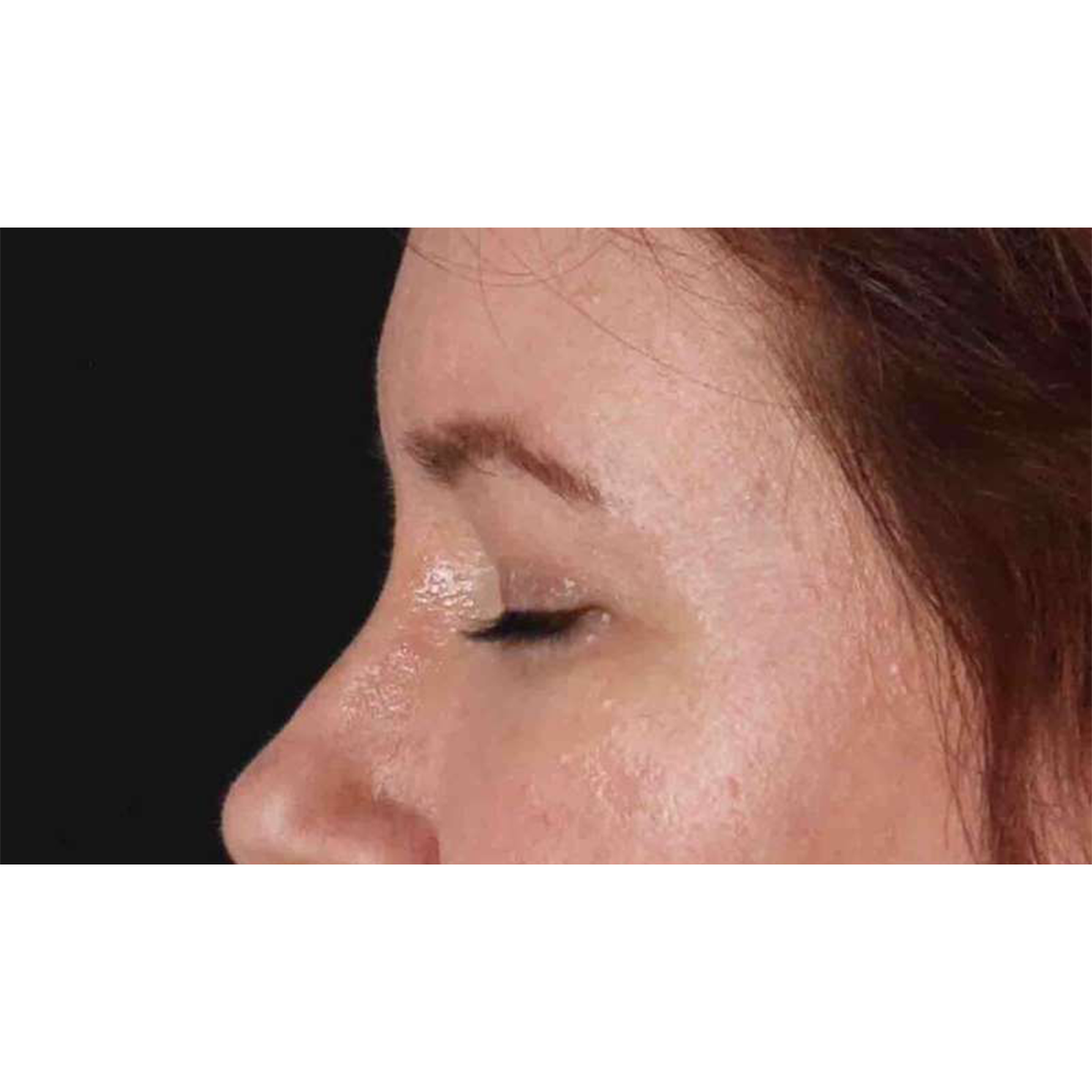 Eyelid Surgery Before & After Patient #1814