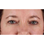 Eyelid Surgery Before & After Patient #1814