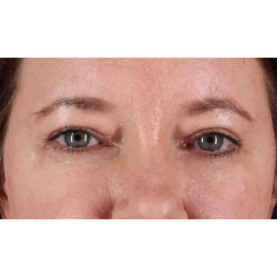 Eyelid Surgery Before & After Patient #1814