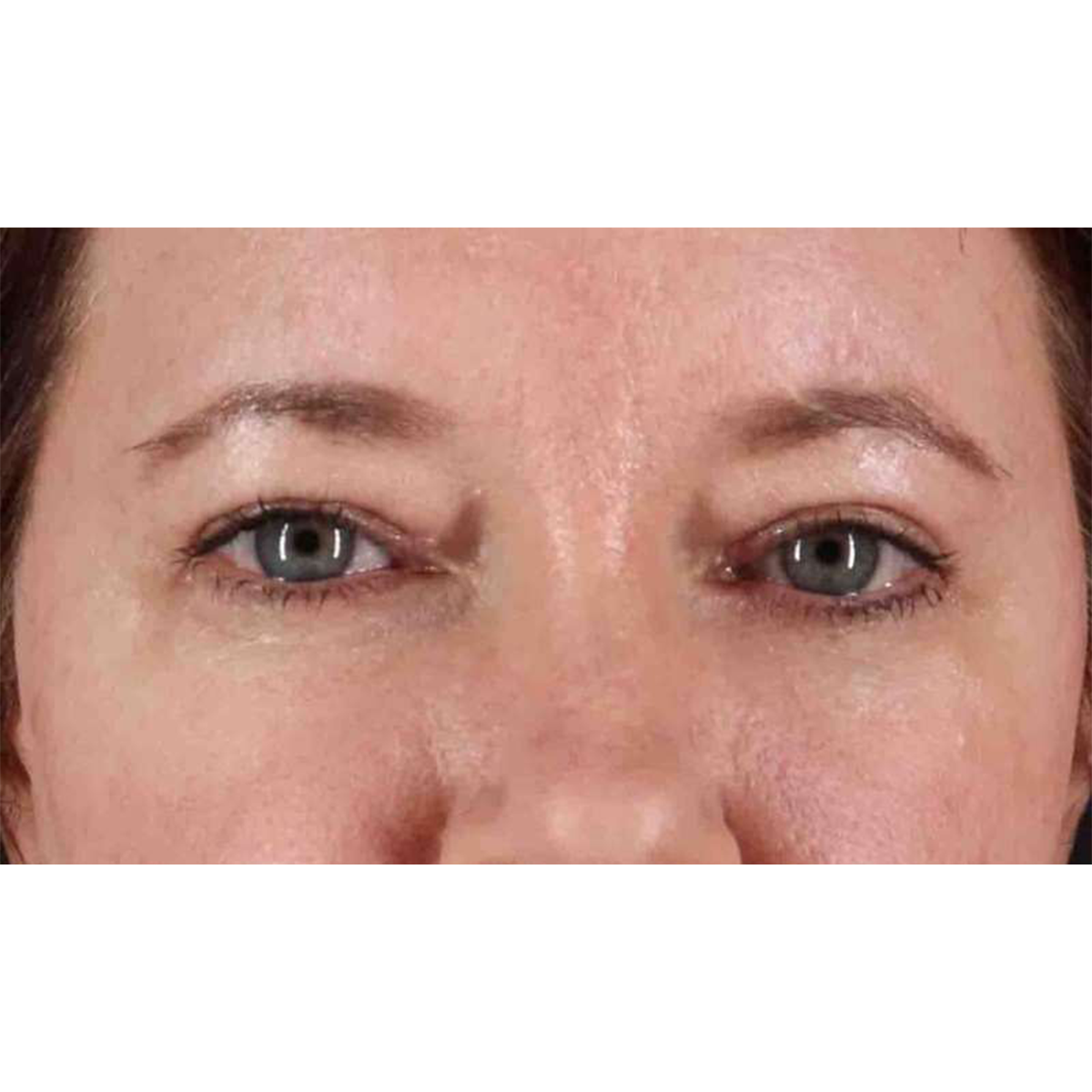 Eyelid Surgery Before & After Patient #1814