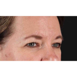 Eyelid Surgery Before & After Patient #1814