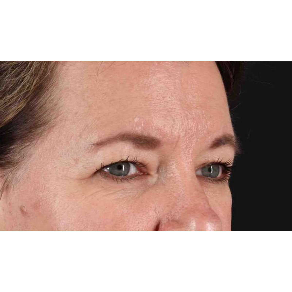 Eyelid Surgery Before & After Patient #1814