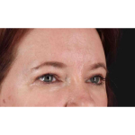 Eyelid Surgery Before & After Patient #1814