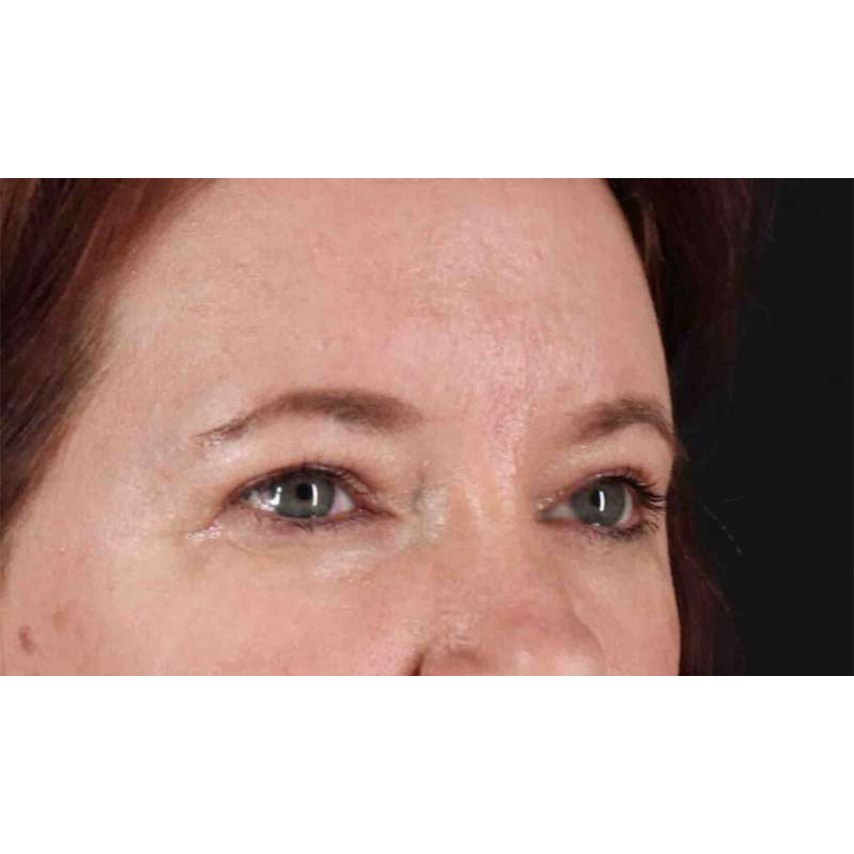 Eyelid Surgery Before & After Patient #1814