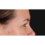 Eyelid Surgery Before & After Patient #1814