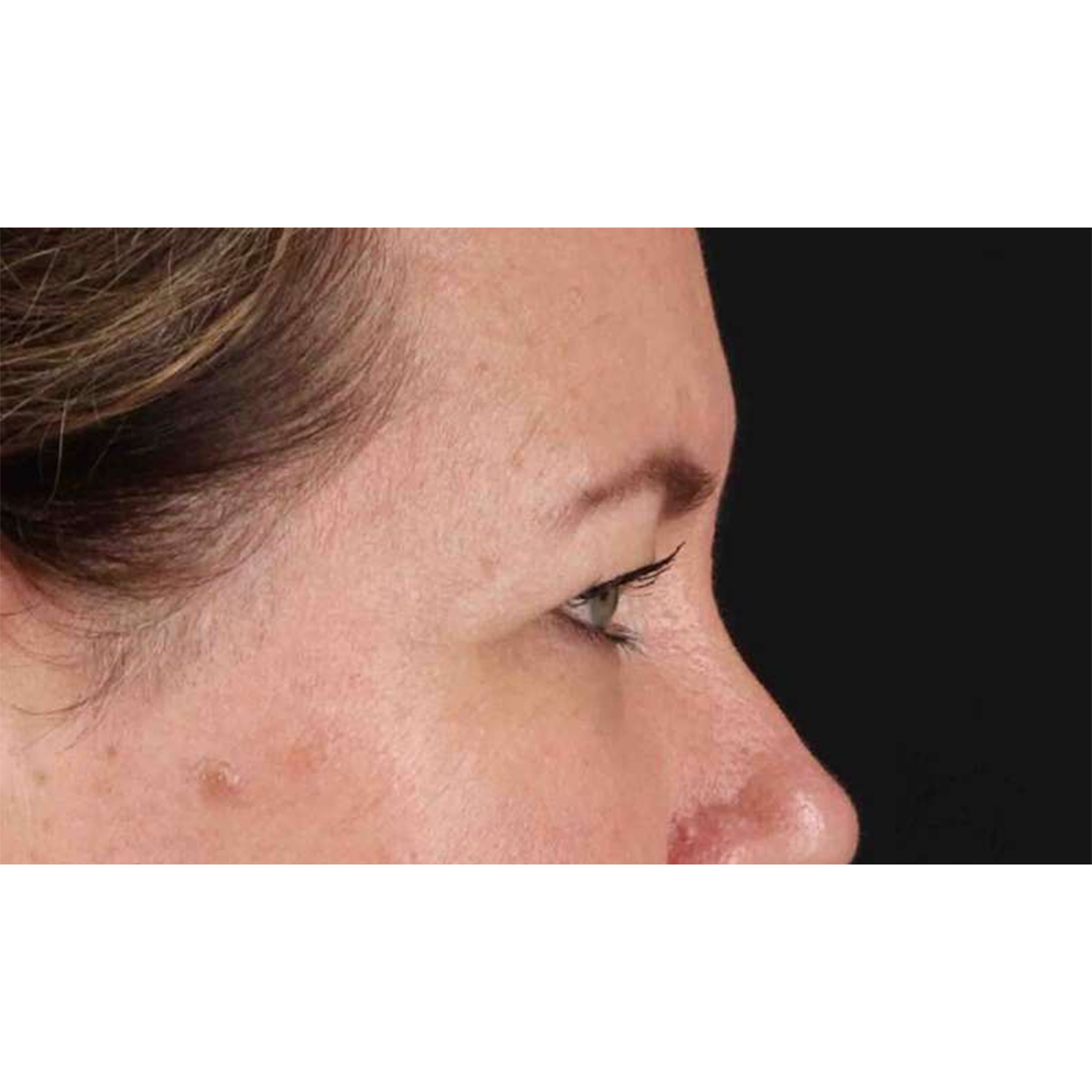 Eyelid Surgery Before & After Patient #1814