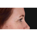 Eyelid Surgery Before & After Patient #1814