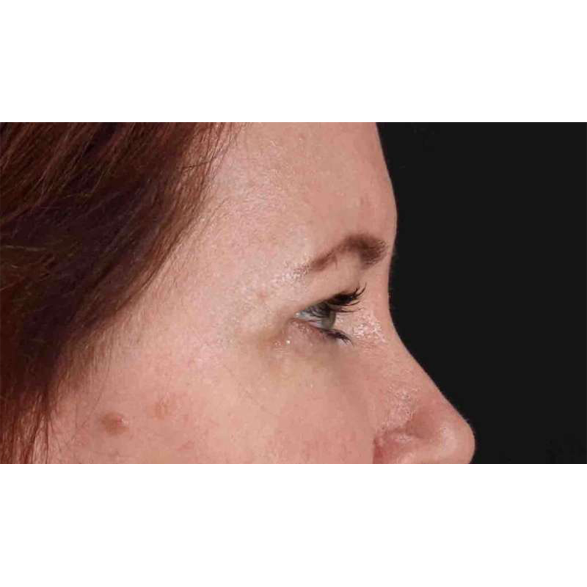 Eyelid Surgery Before & After Patient #1814