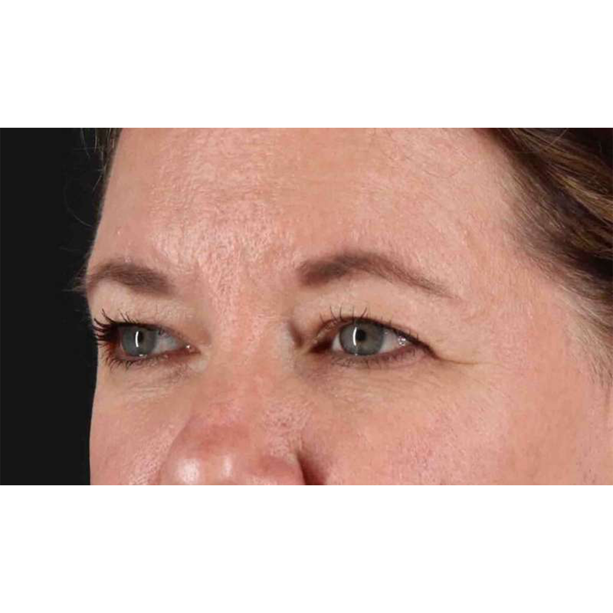 Eyelid Surgery Before & After Patient #1814