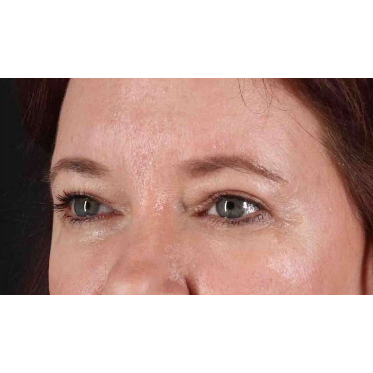 Eyelid Surgery Before & After Patient #1814