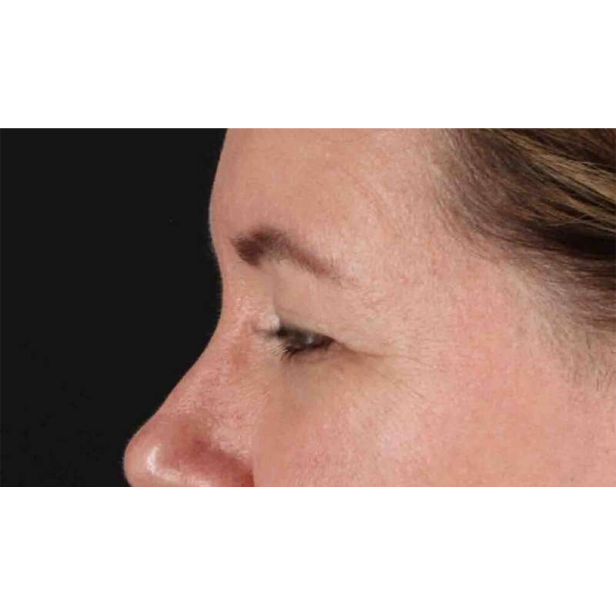 Eyelid Surgery Before & After Patient #1814