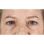 Eyelid Surgery Before & After Patient #1825