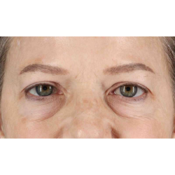 Eyelid Surgery Before & After Patient #1825