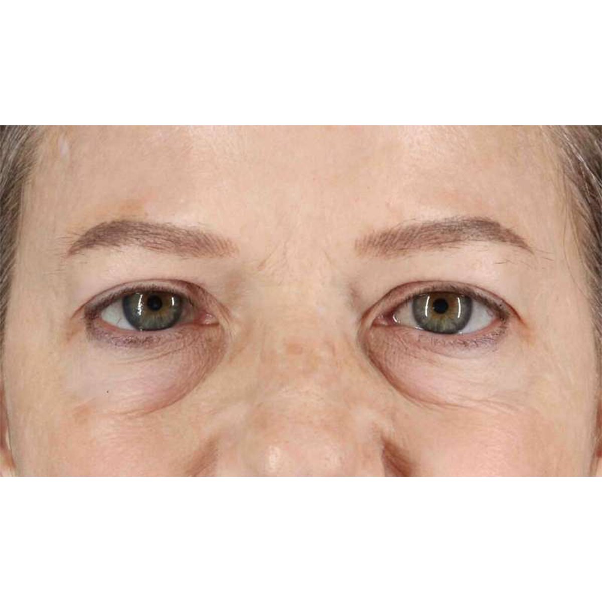 Eyelid Surgery Before & After Patient #1825
