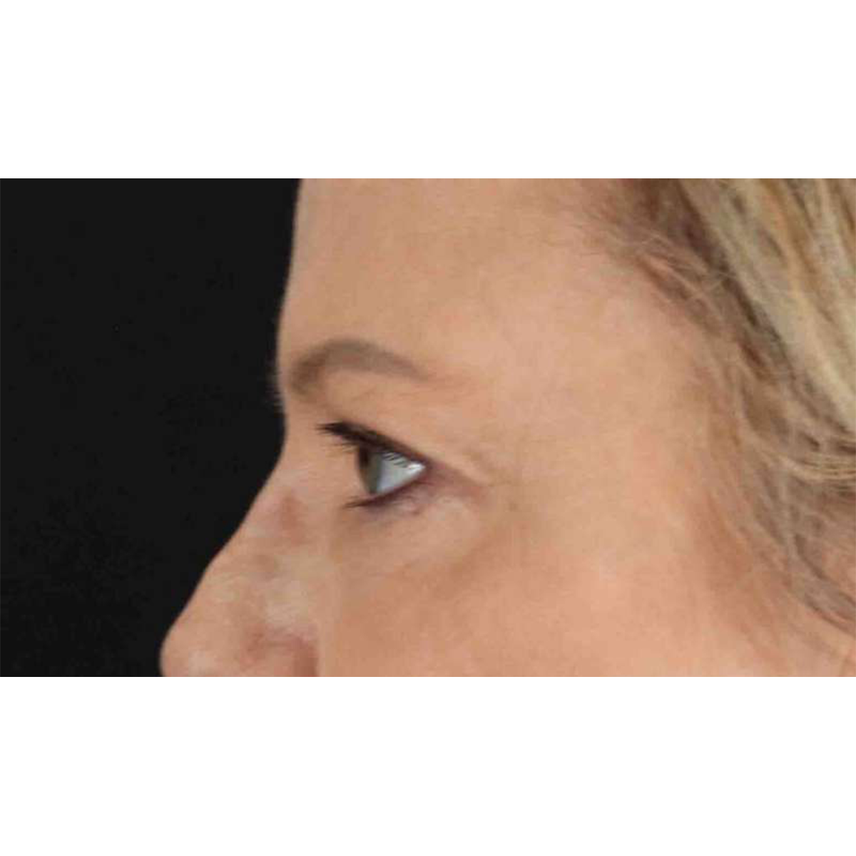 Eyelid Surgery Before & After Patient #1825