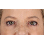 Eyelid Surgery Before & After Patient #1825