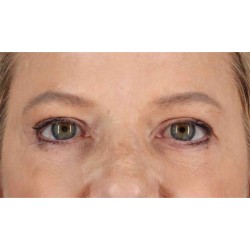 Eyelid Surgery Before & After Patient #1825