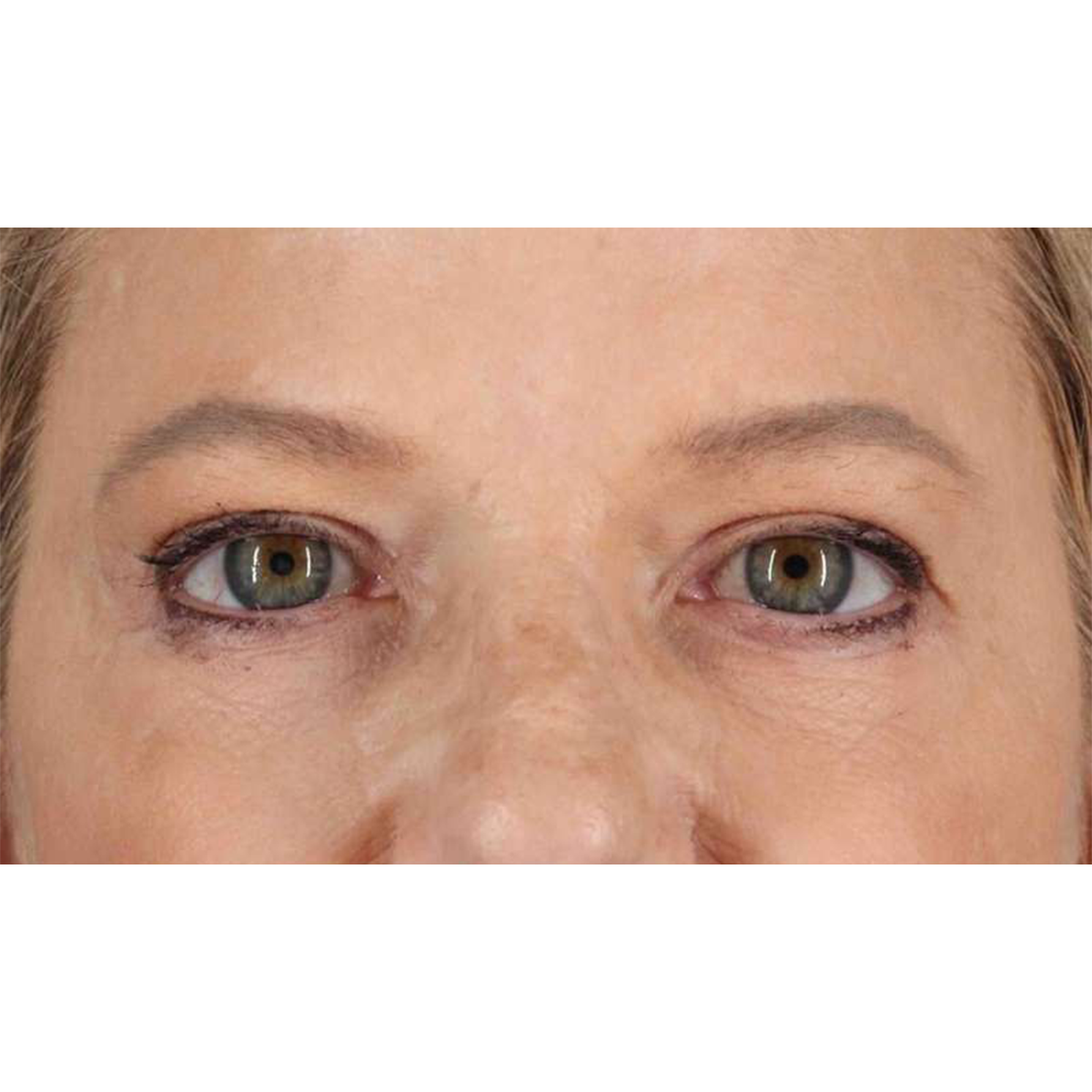 Eyelid Surgery Before & After Patient #1825