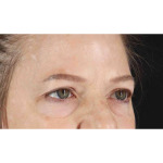 Eyelid Surgery Before & After Patient #1825