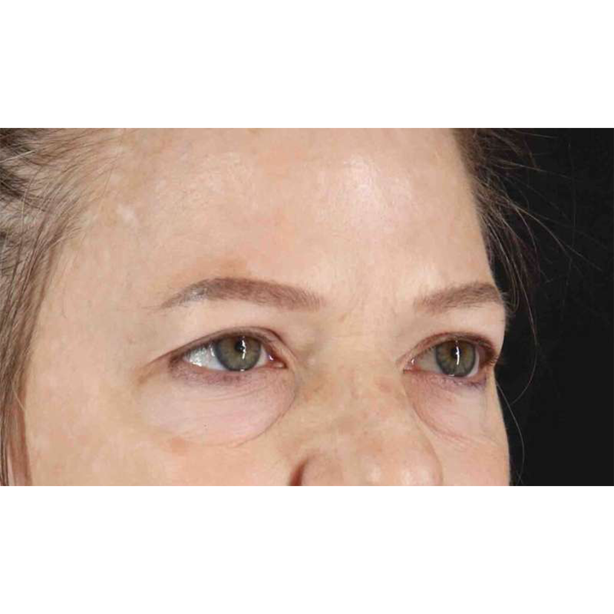 Eyelid Surgery Before & After Patient #1825