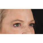 Eyelid Surgery Before & After Patient #1825