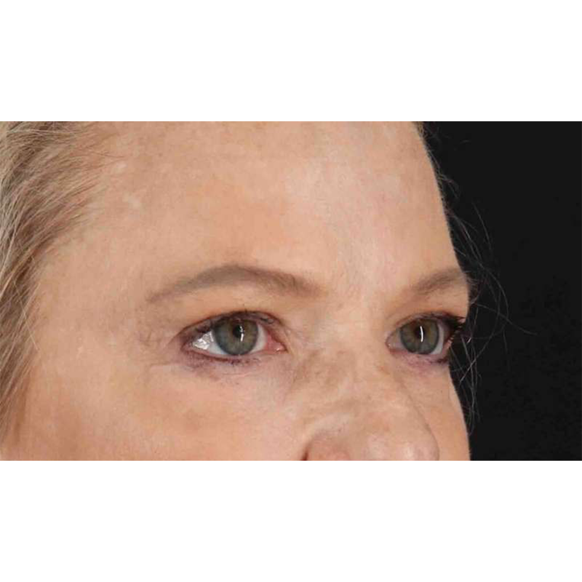 Eyelid Surgery Before & After Patient #1825