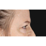 Eyelid Surgery Before & After Patient #1825