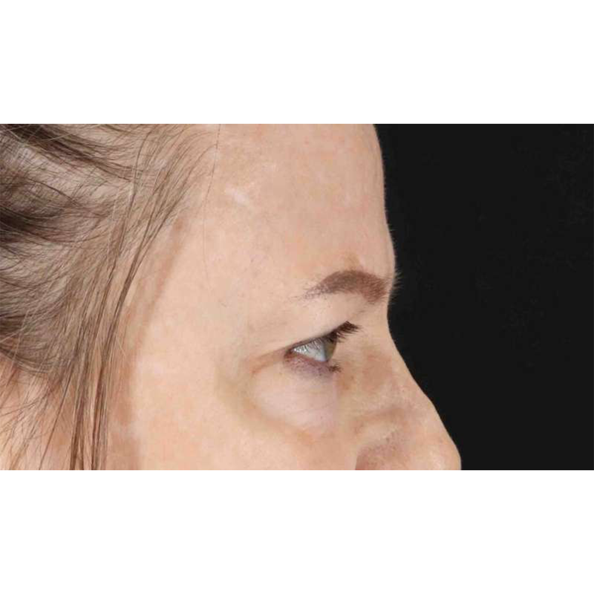 Eyelid Surgery Before & After Patient #1825