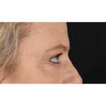Eyelid Surgery Before & After Patient #1825