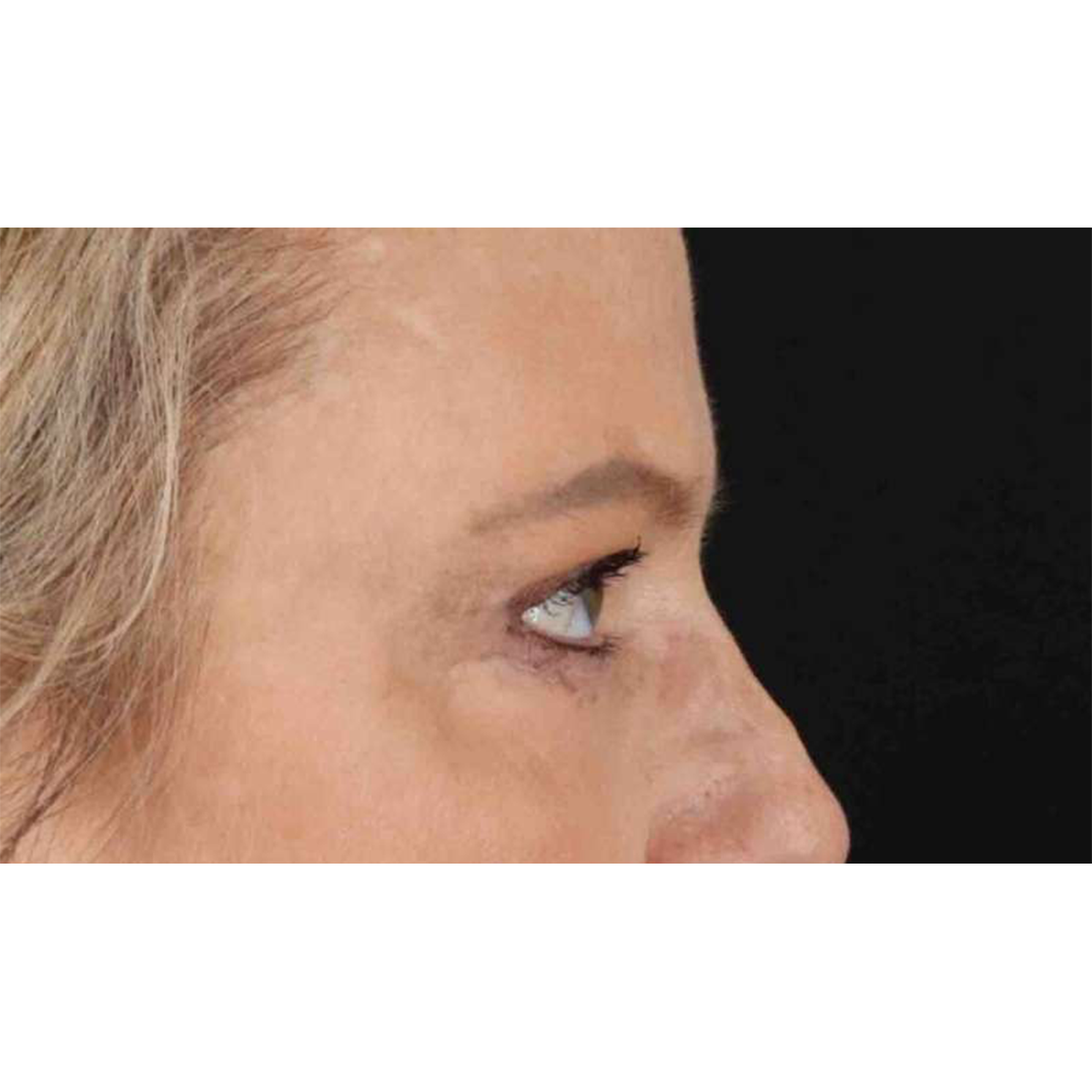 Eyelid Surgery Before & After Patient #1825