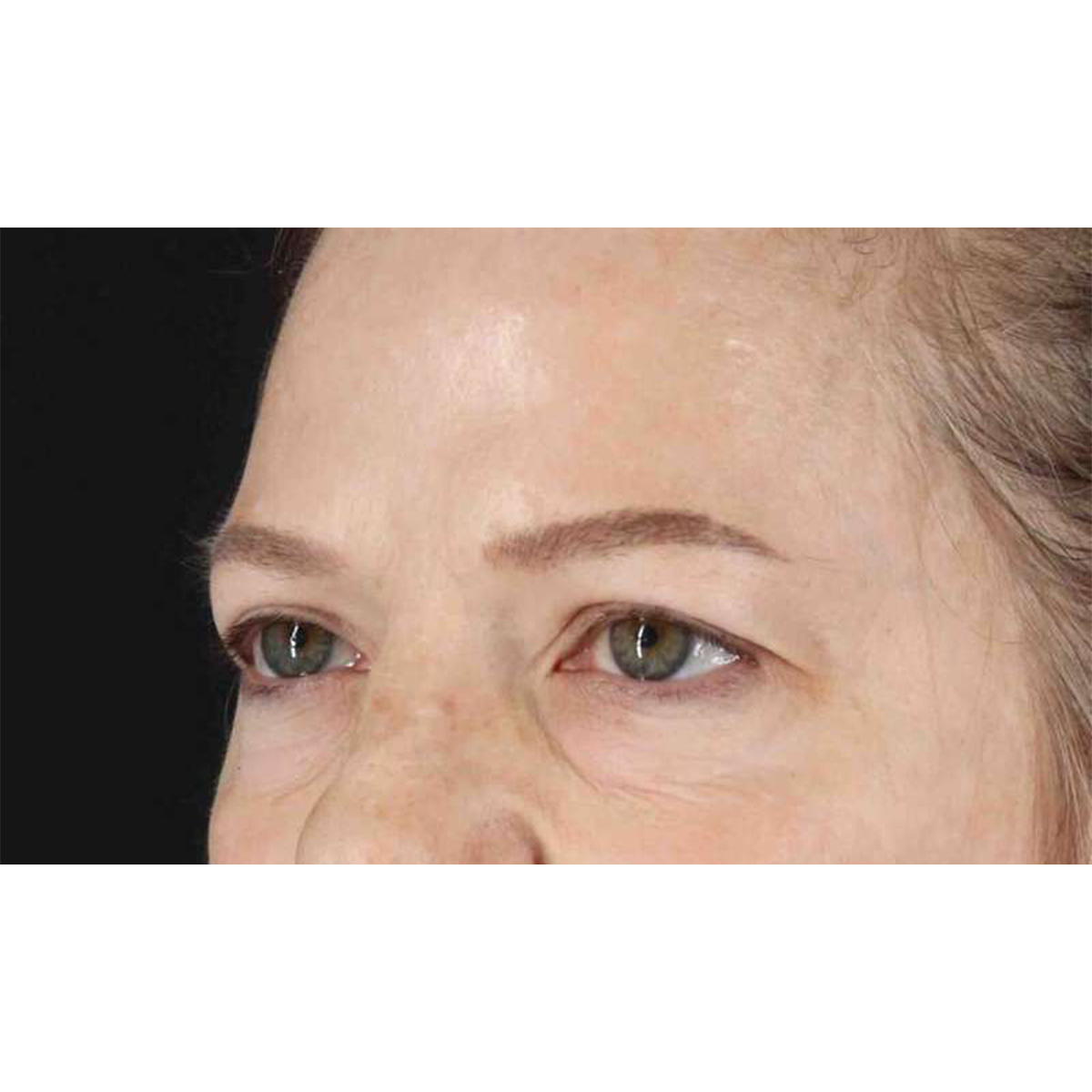 Eyelid Surgery Before & After Patient #1825