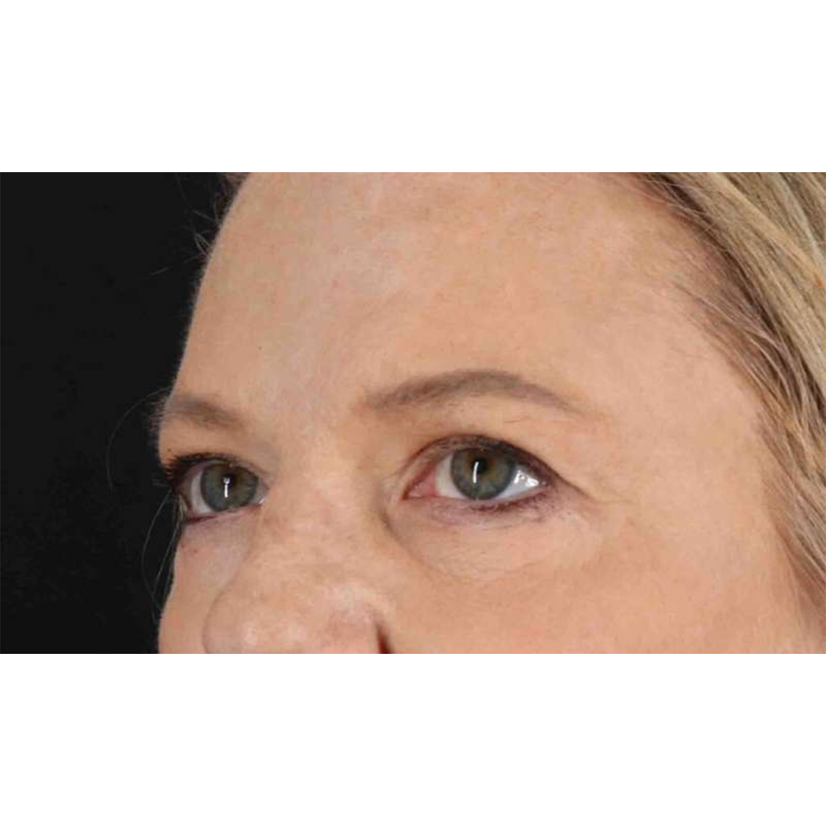 Eyelid Surgery Before & After Patient #1825