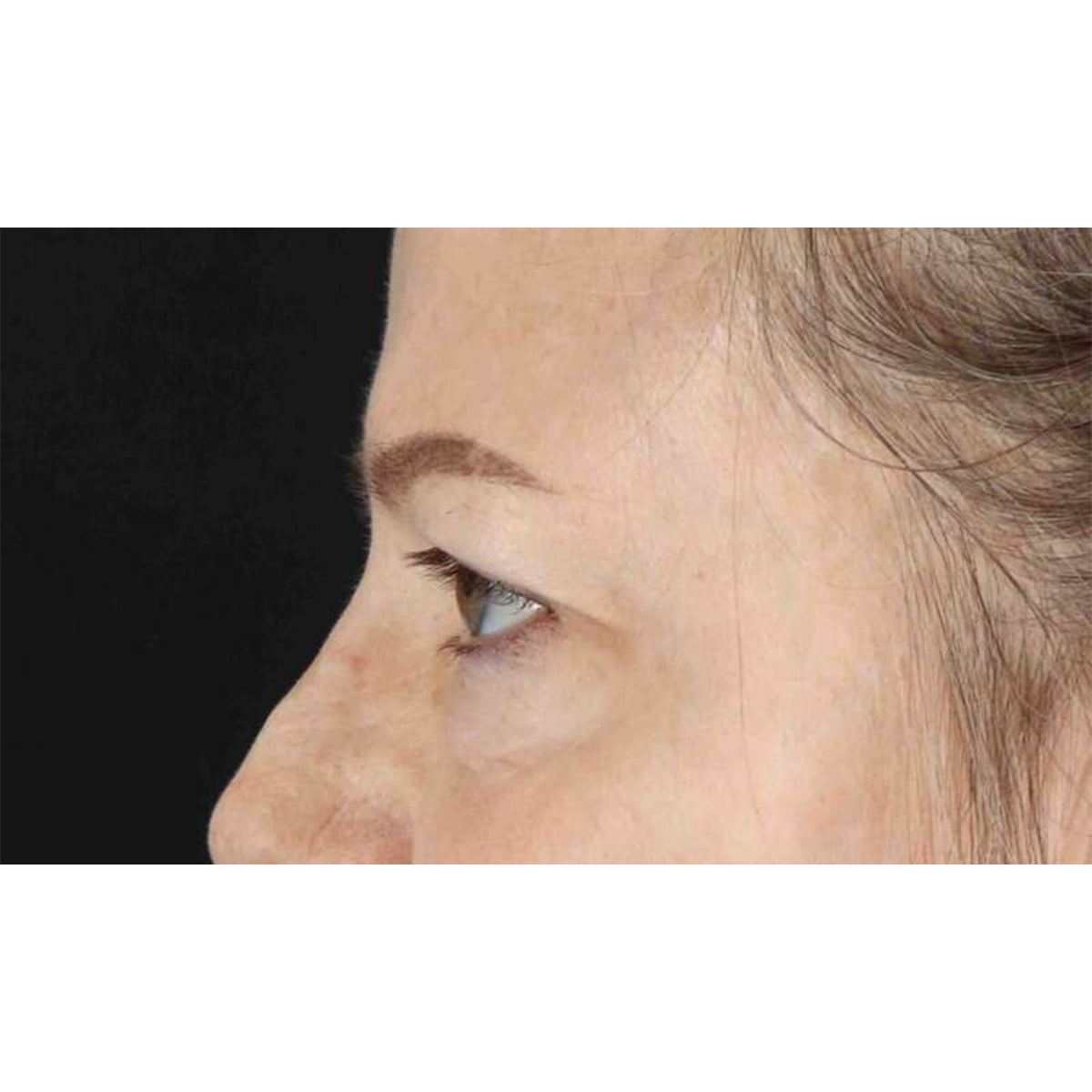 Eyelid Surgery Before & After Patient #1825