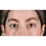 Eyelid Surgery Before & After Patient #1836
