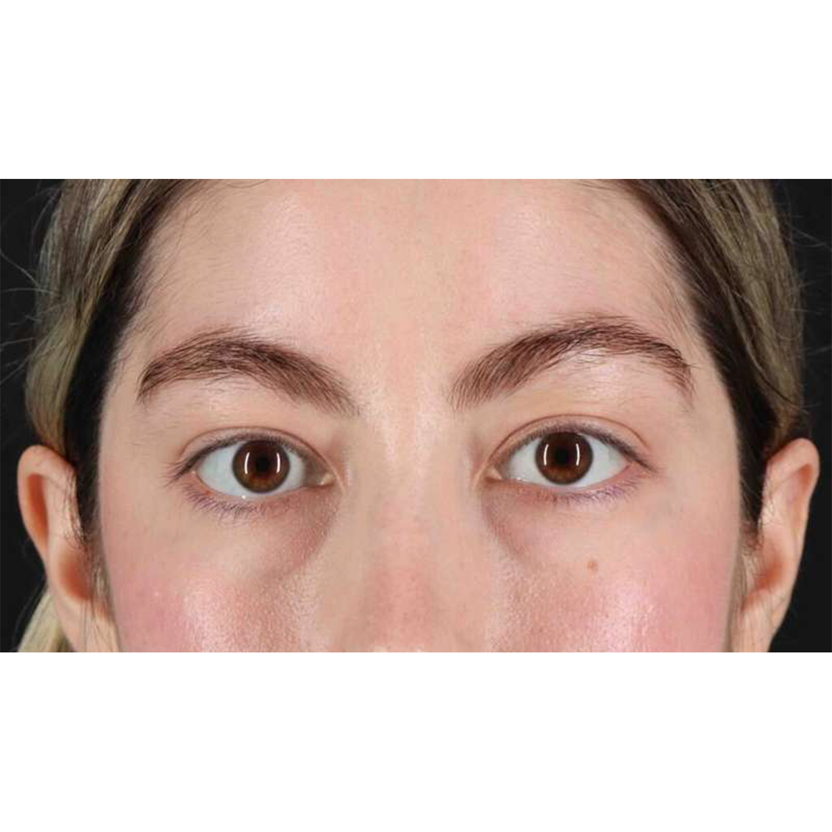 Eyelid Surgery Before & After Patient #1836