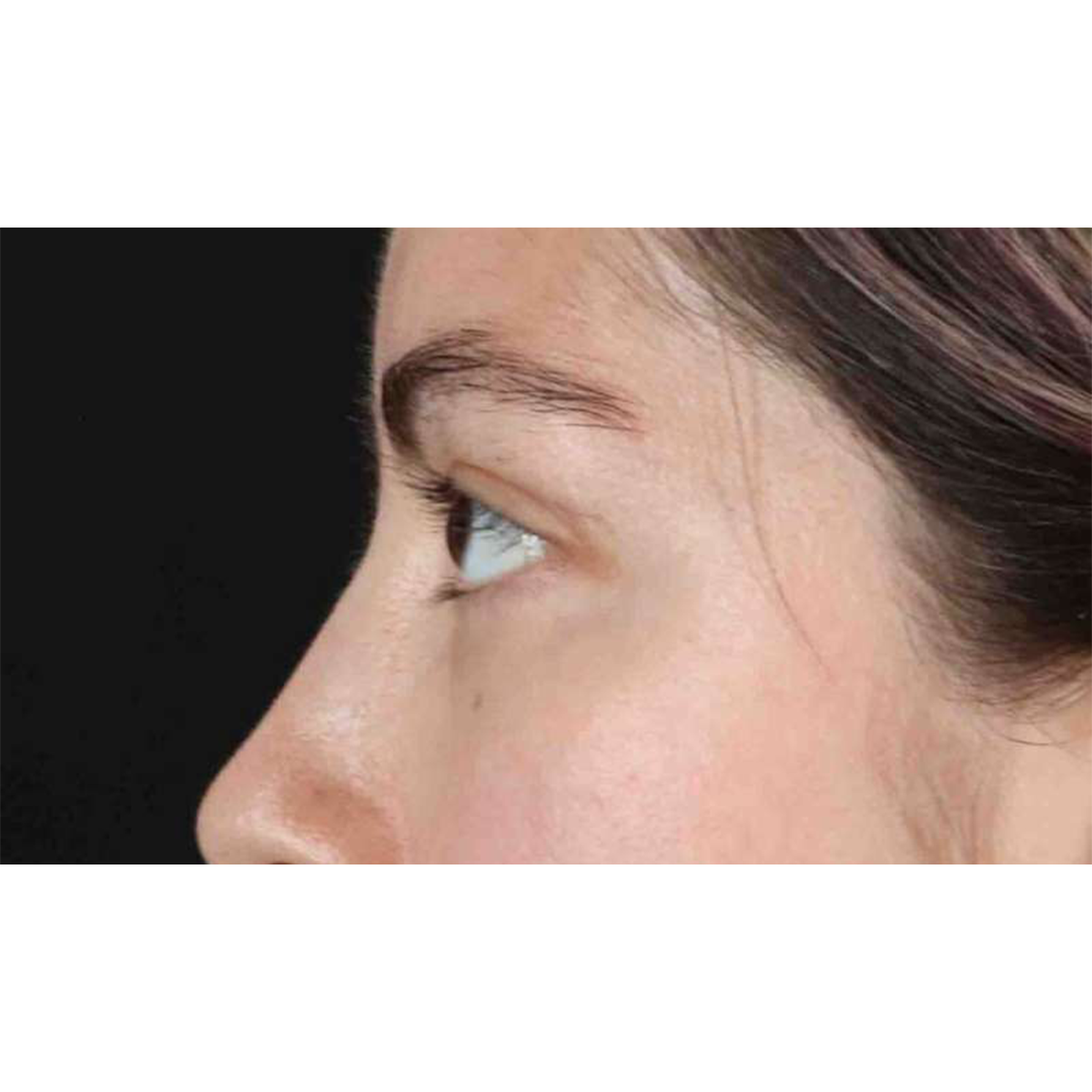 Eyelid Surgery Before & After Patient #1836