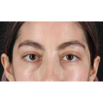 Eyelid Surgery Before & After Patient #1836