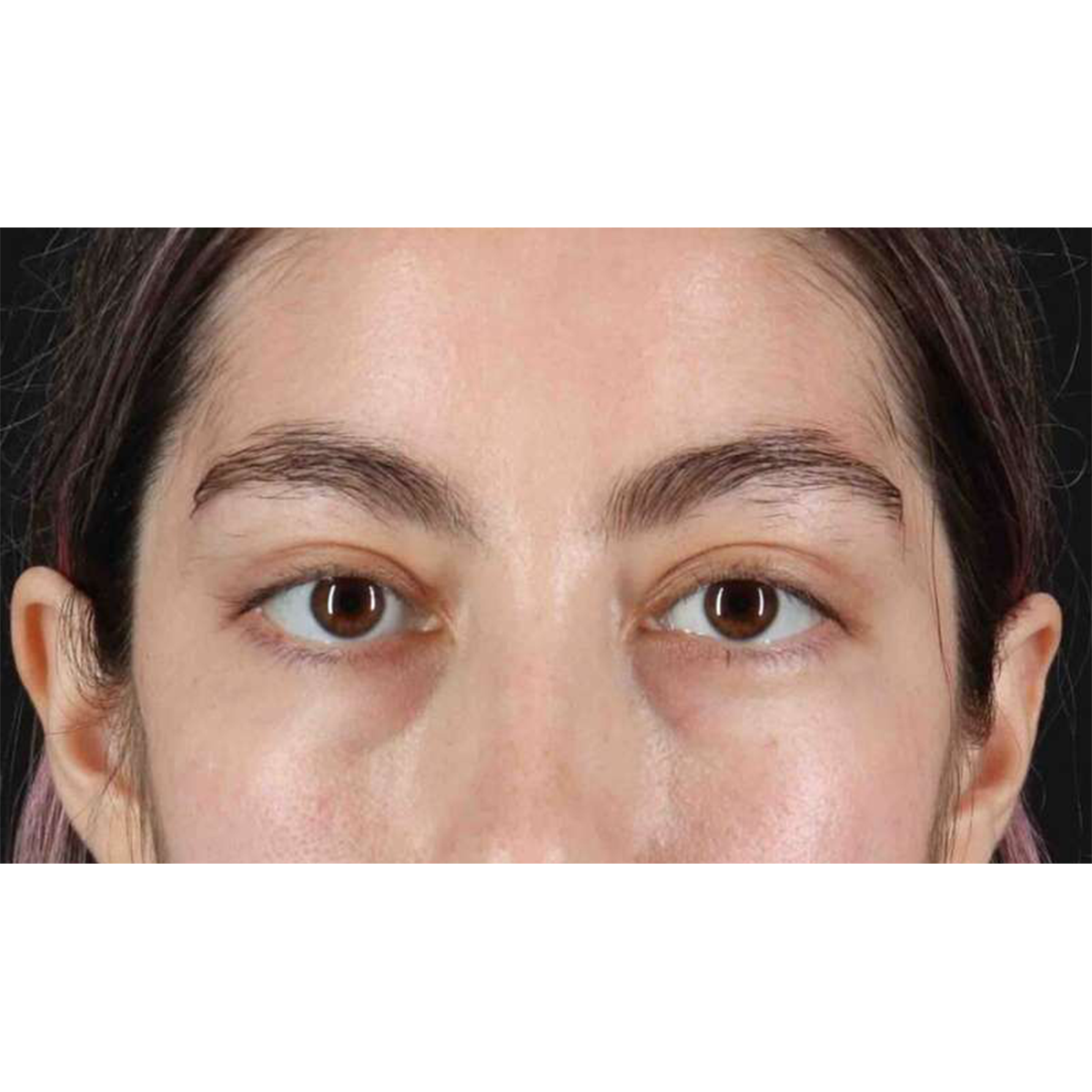 Eyelid Surgery Before & After Patient #1836