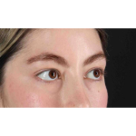 Eyelid Surgery Before & After Patient #1836