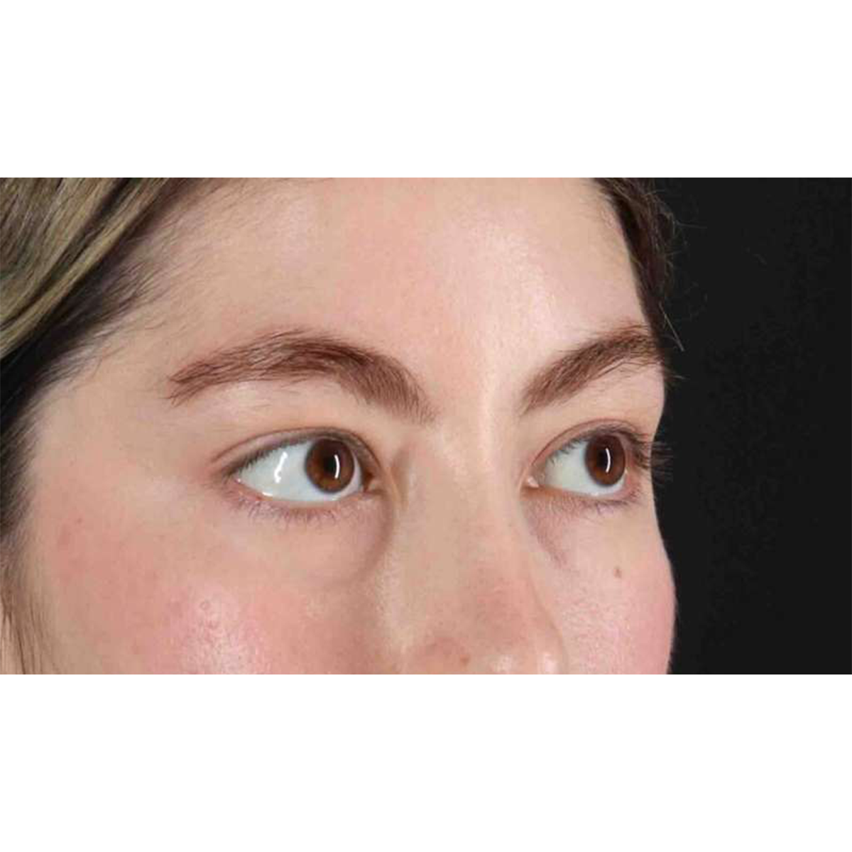 Eyelid Surgery Before & After Patient #1836